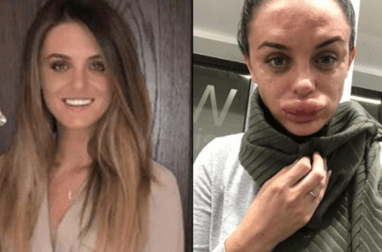 Woman\'s lips swell thrice their size after botox accident